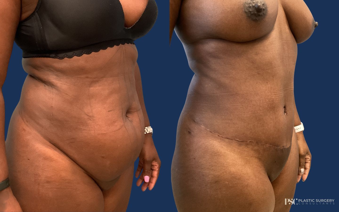 Before and after Liposuction case 26248 - Angle 2