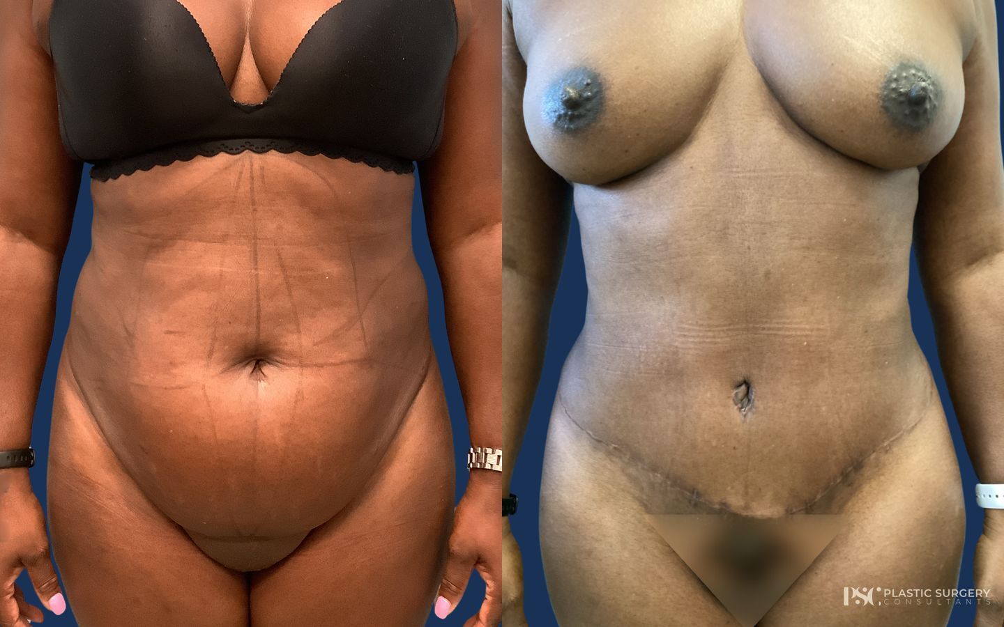 Before and after Liposuction case 26248