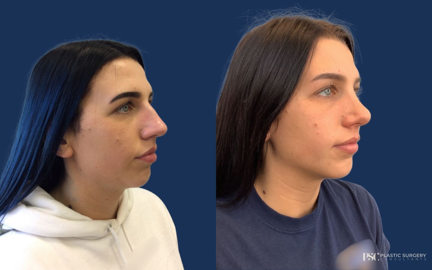 Before and after Septoplasty case 46071