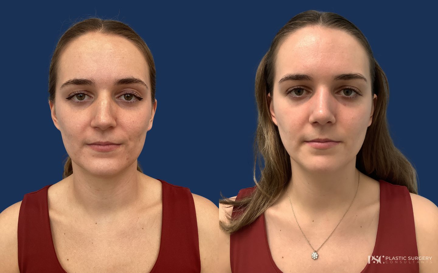 Before and after Rhinoplasty case 23885 - Angle 2