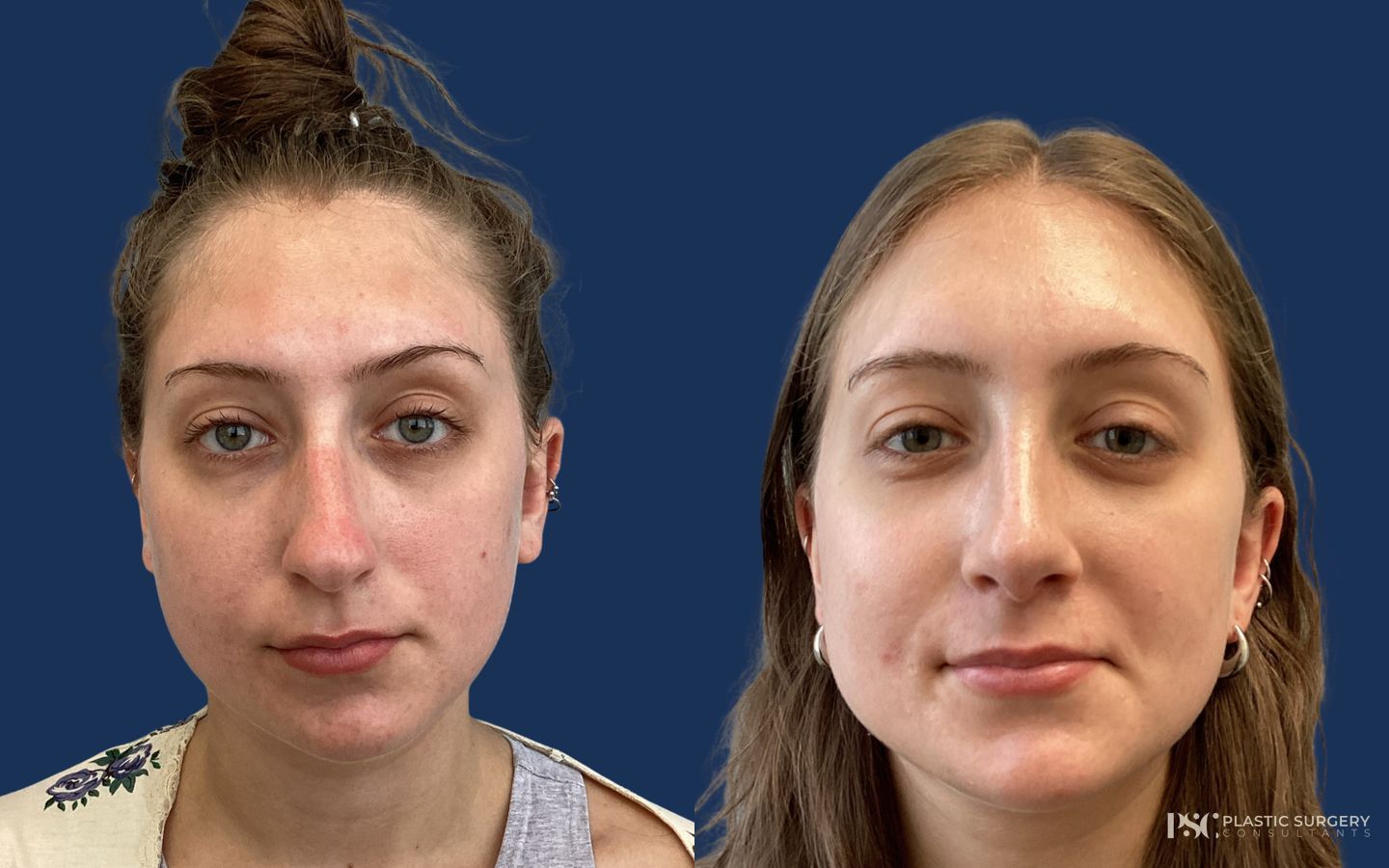 Before and after Rhinoplasty case 26246 - Angle 2