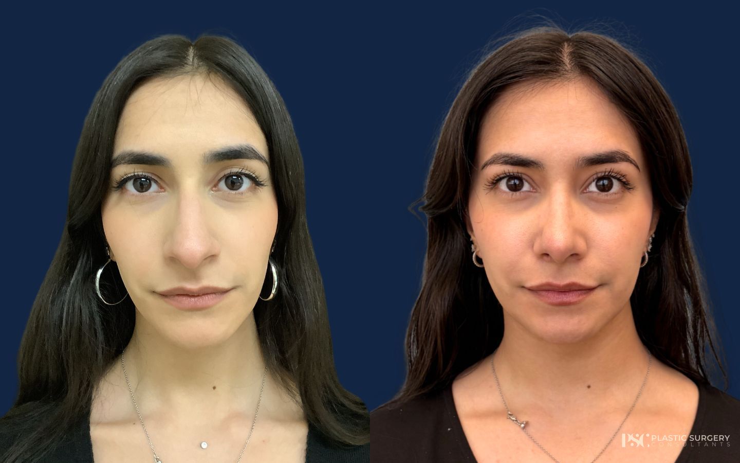 Before and after Rhinoplasty case 49523 - Angle 2