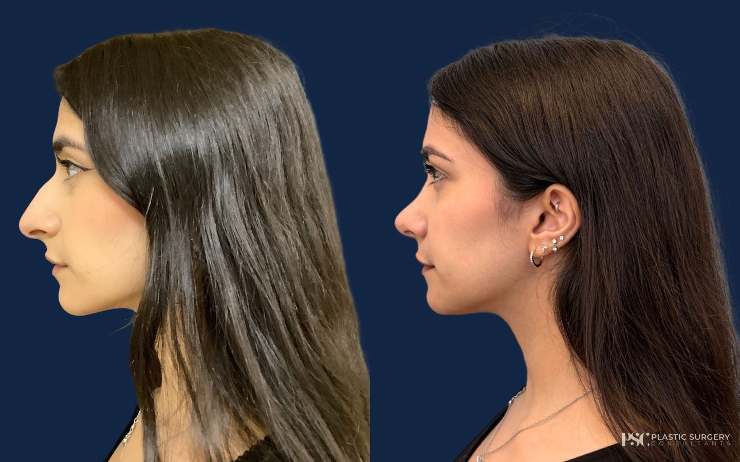 Before and after Rhinoplasty case 49523
