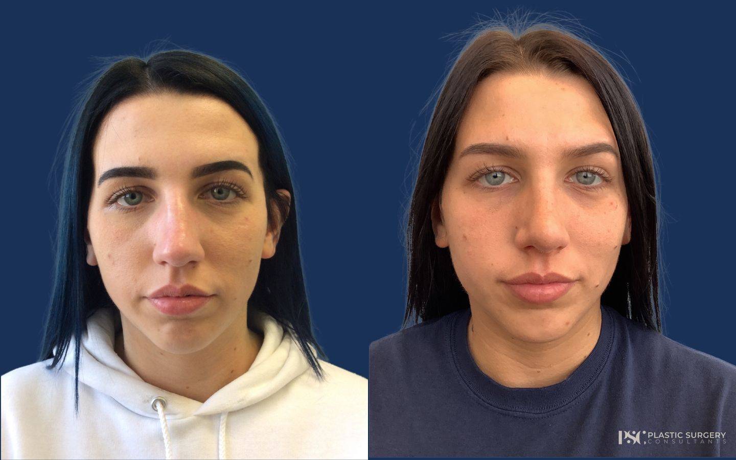 Before and after Septoplasty case 46071 - Angle 2