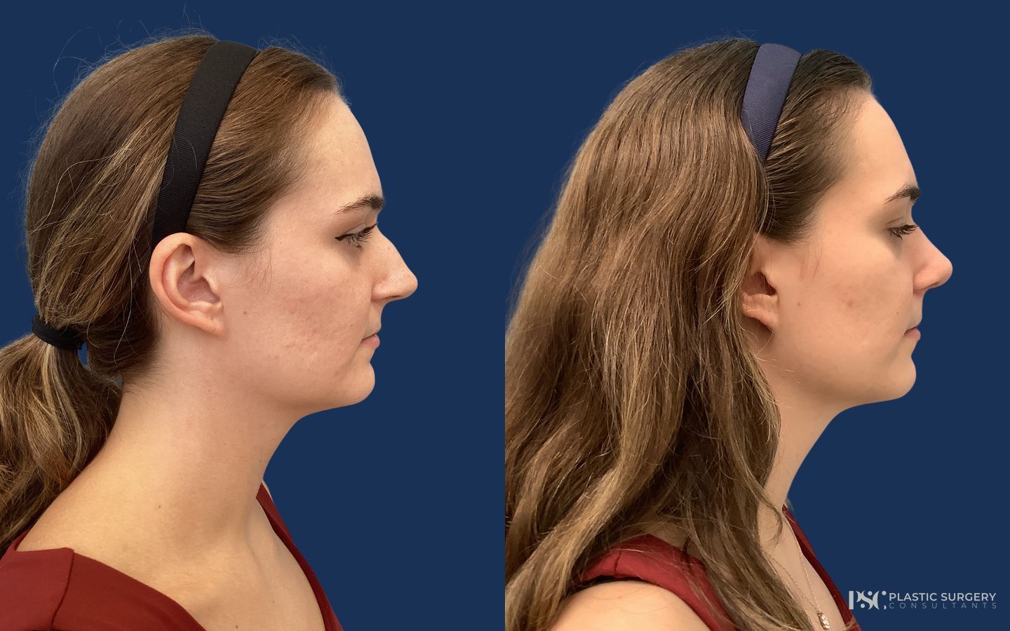 Before and after Rhinoplasty case 23885