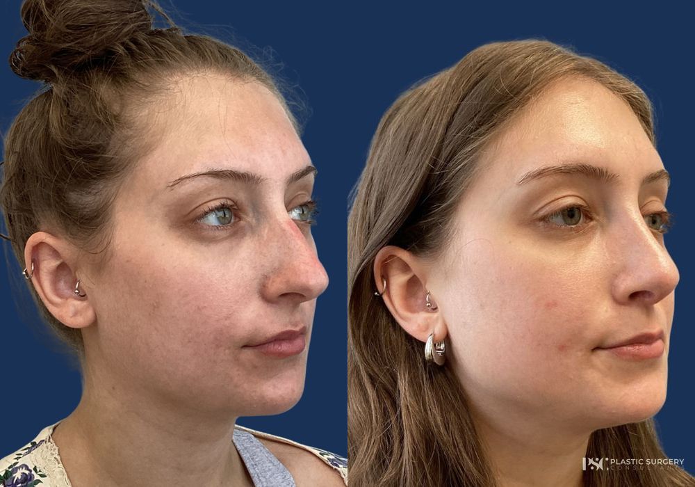 Before and after Dr. Richard J. Wassermann case 26246