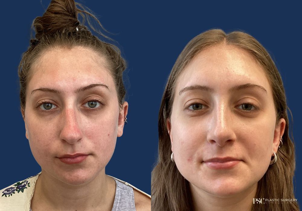 Before and after Dr. Richard J. Wassermann case 26246 - Angle 2