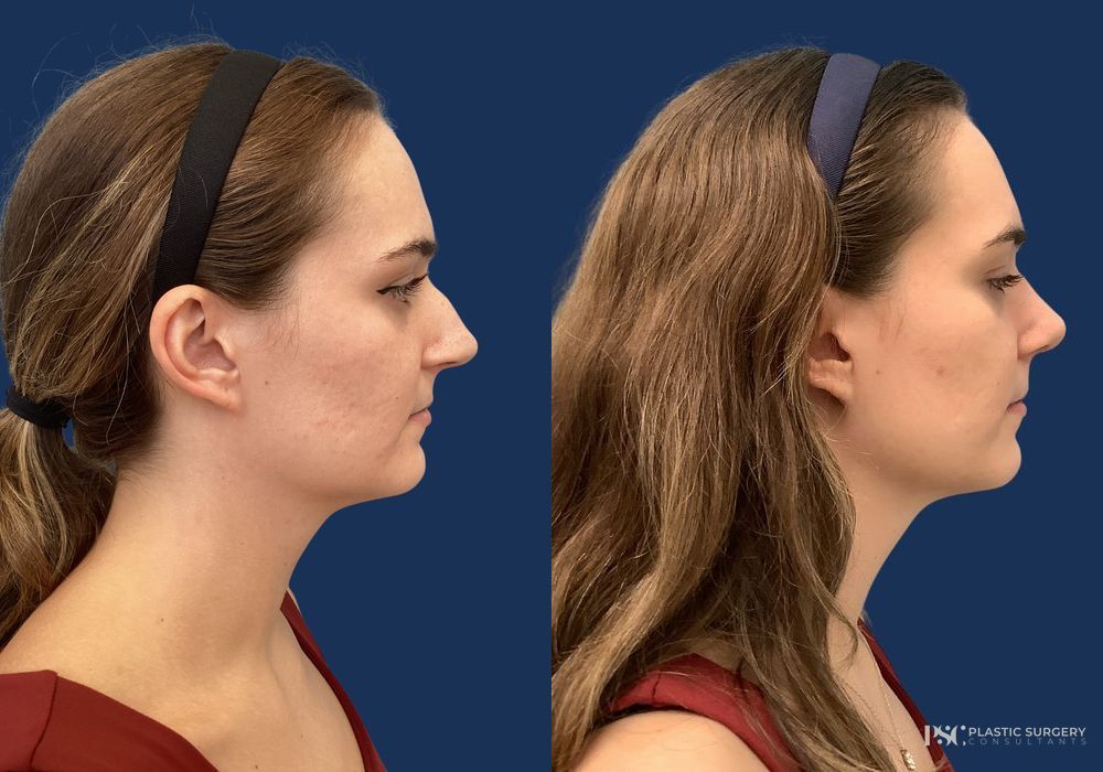 Before and after Dr. Richard J. Wassermann case 23885