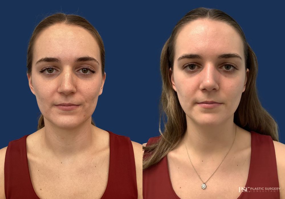 Before and after Dr. Richard J. Wassermann case 23885 - Angle 2
