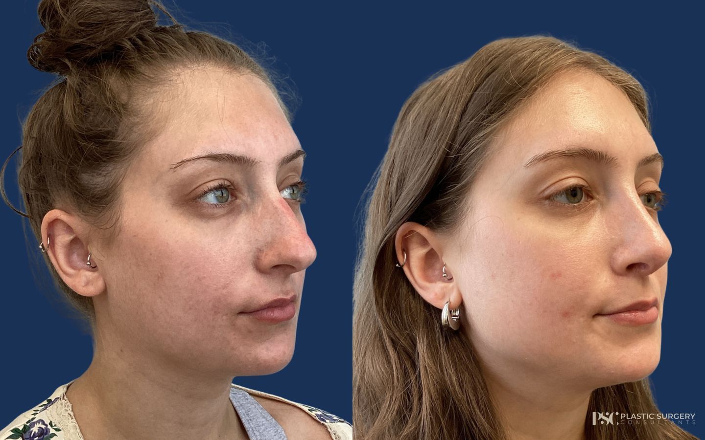 Before and after Rhinoplasty case 26246