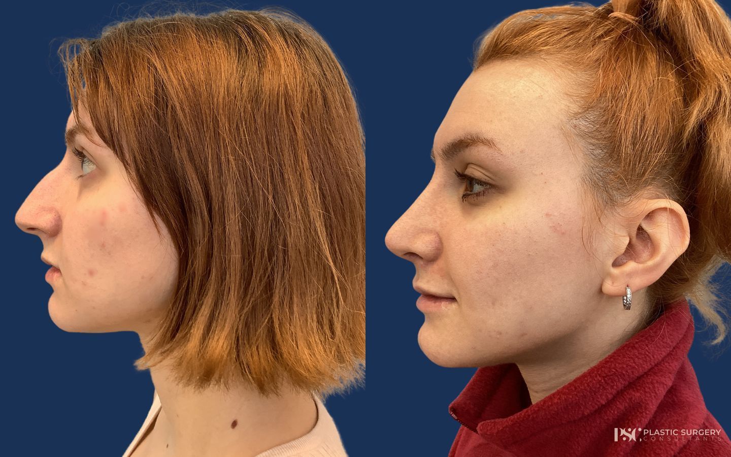 Before and after Septoplasty case 46336