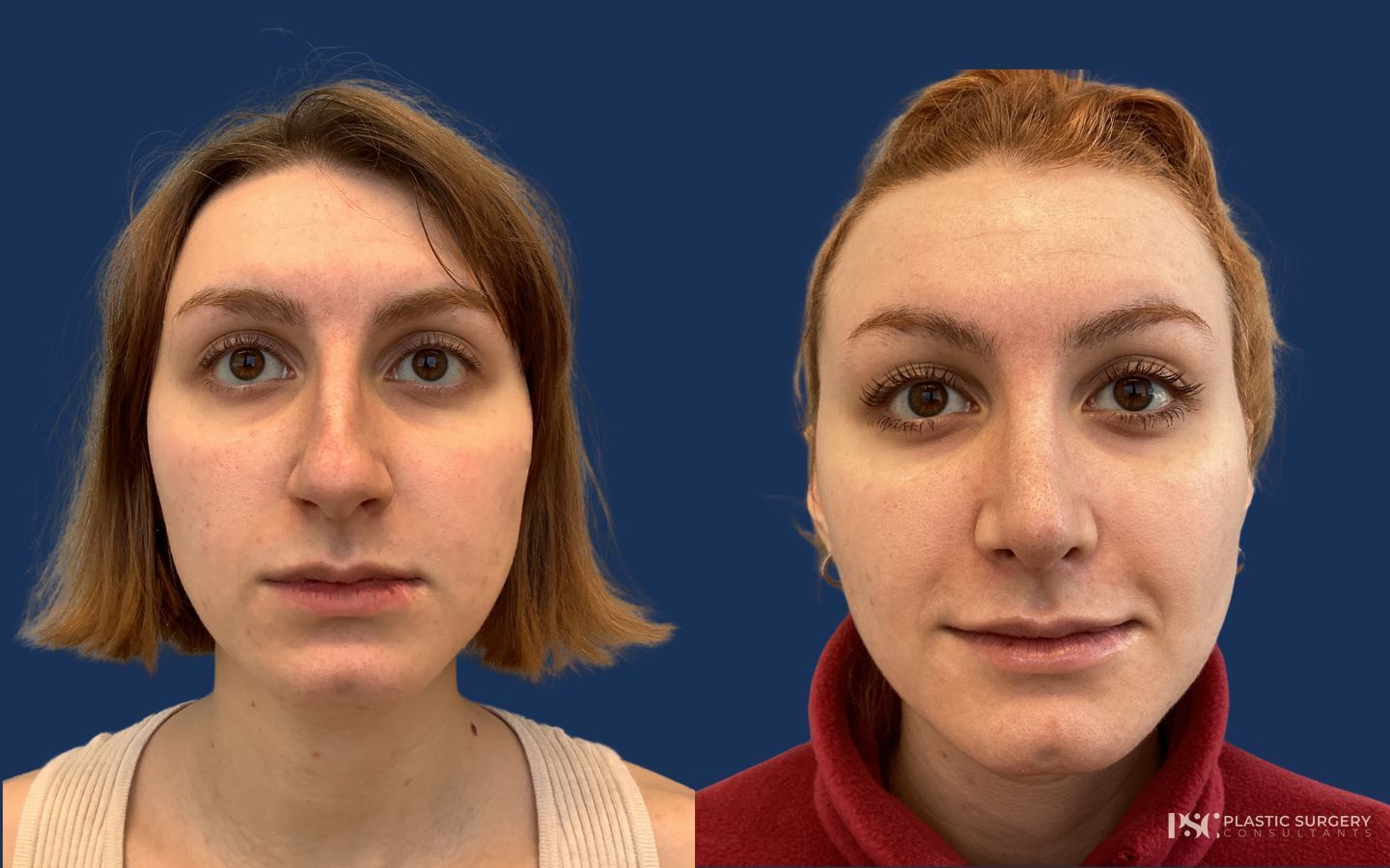 Before and after Septoplasty case 46336 - Angle 2