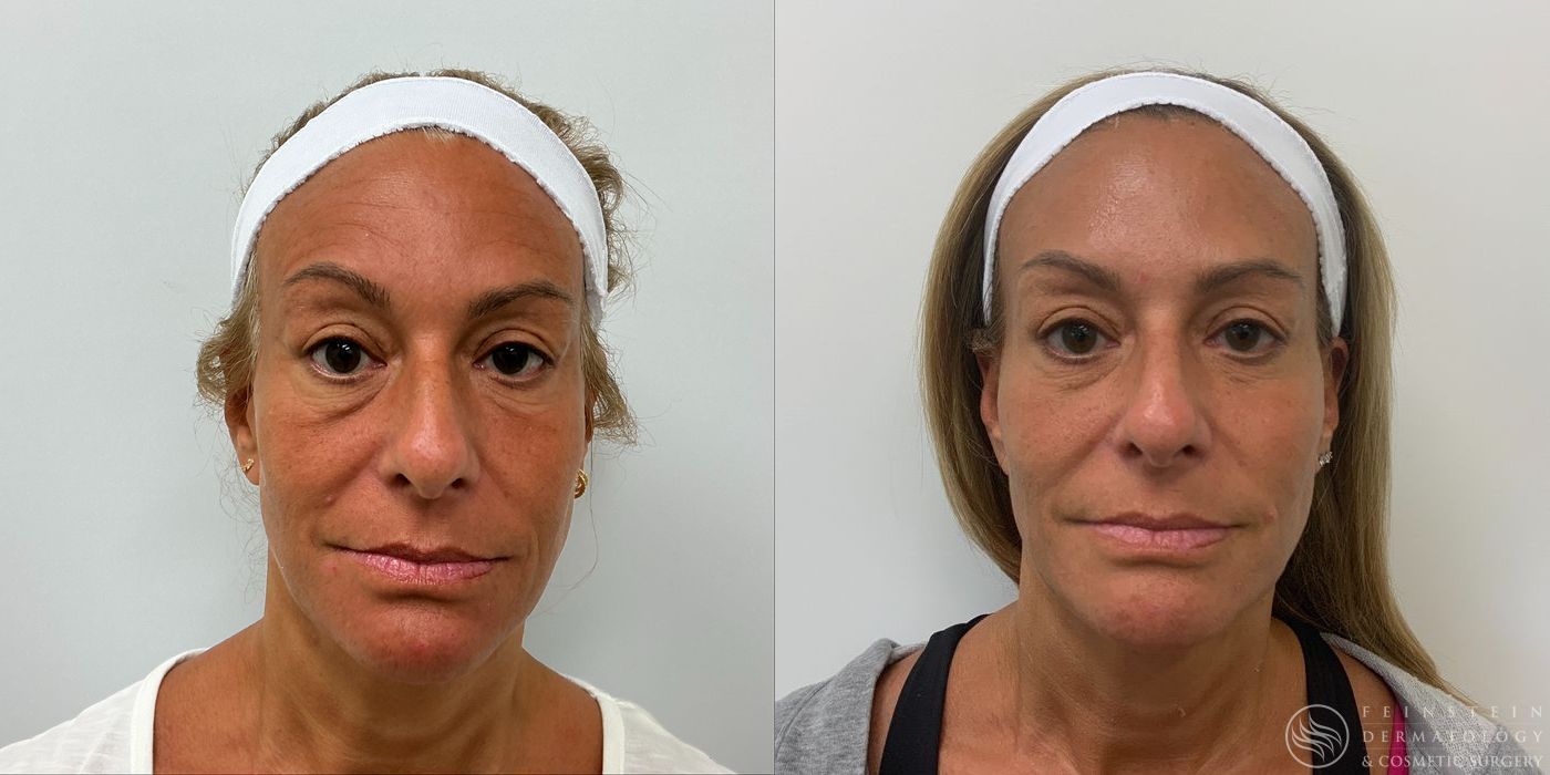 Dermal Fillers - Case 12251