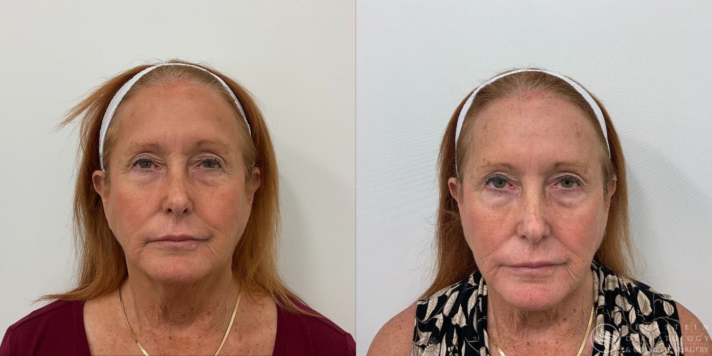 Botox Cosmetic, Dysport, Jeveau - Case 12223