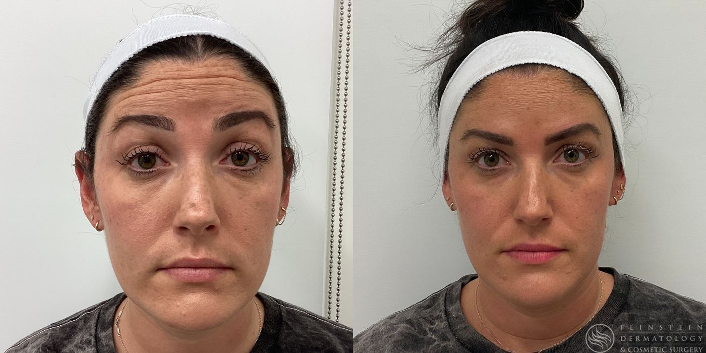 Botox Cosmetic, Dysport, Jeveau - Thumbnail 2