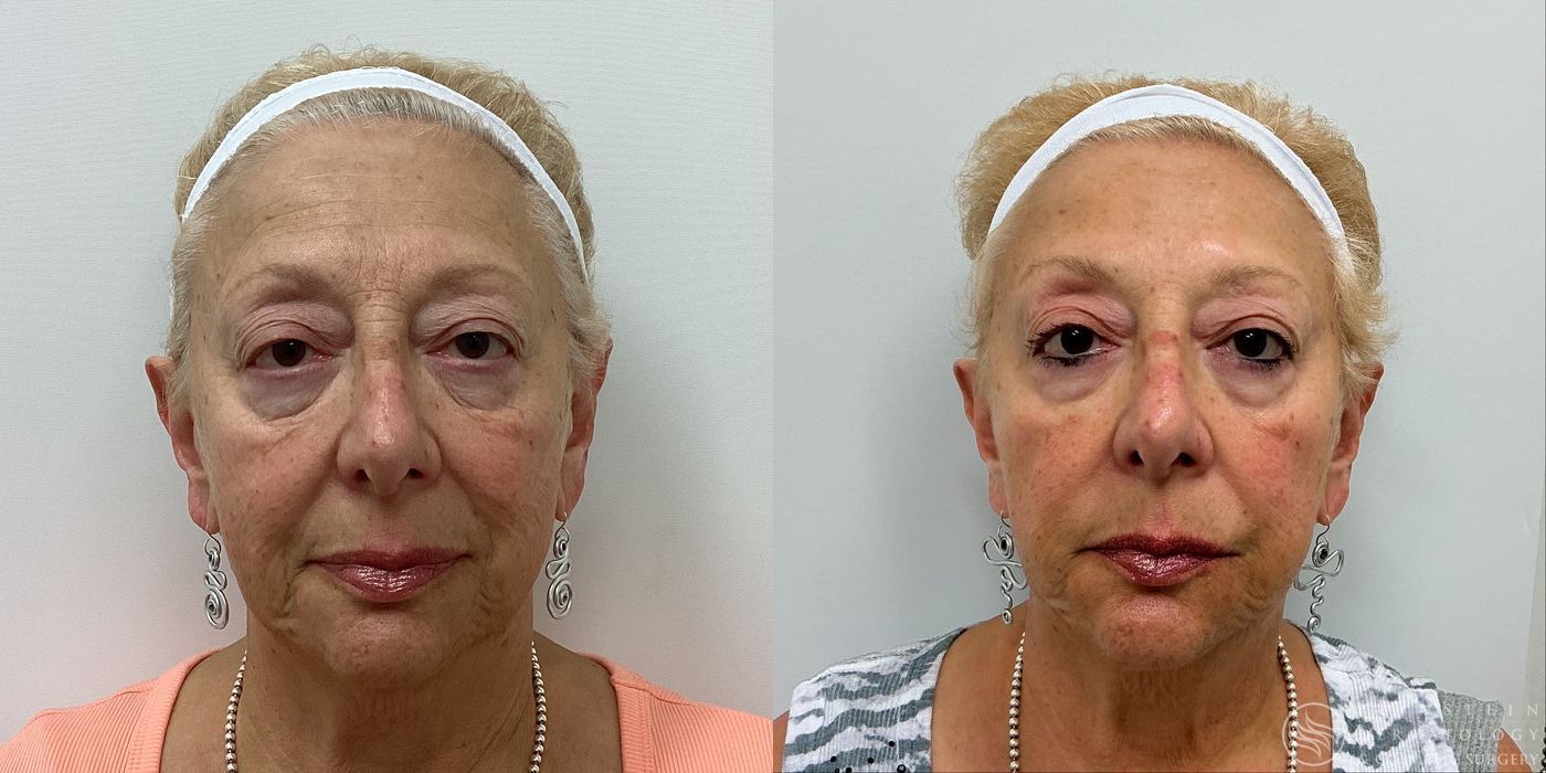 Dermal Fillers - Case 12252