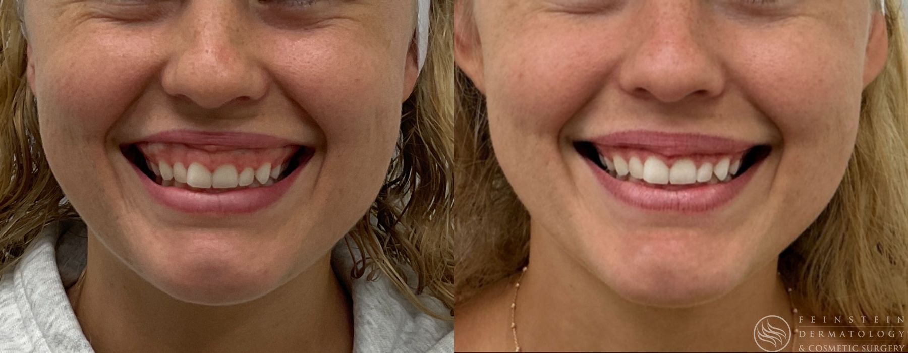 Botox Cosmetic, Dysport, Jeveau - Case 12224