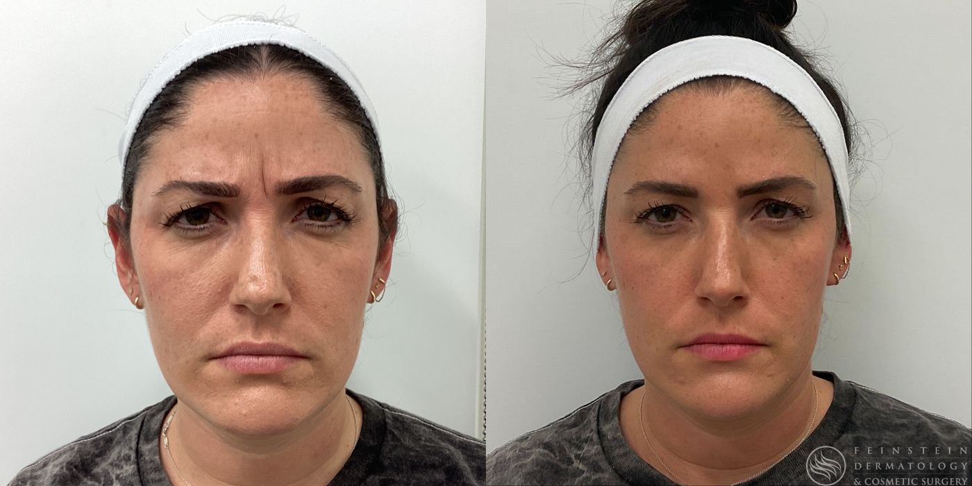 Botox Cosmetic, Dysport, Jeveau - Case 12227