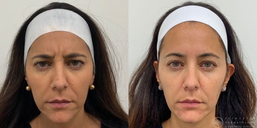 Botox Cosmetic, Dysport, Jeveau - Case 12238