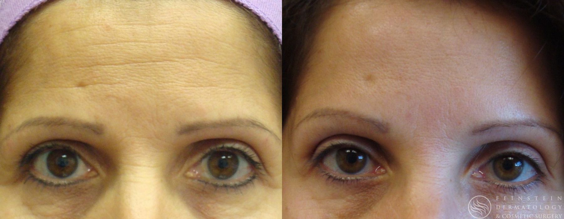 Botox Cosmetic, Dysport, Jeveau - Case 12231