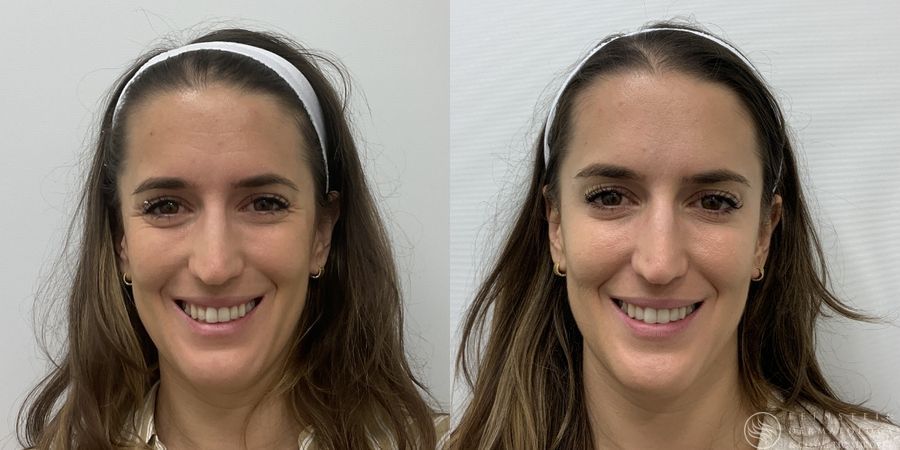 Botox Cosmetic, Dysport, Jeveau - Thumbnail 2