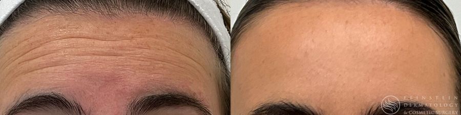 Botox Cosmetic, Dysport, Jeveau - Case 12245