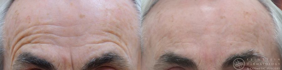 Botox Cosmetic, Dysport, Jeveau - Case 12243