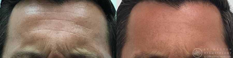 Botox Cosmetic, Dysport, Jeveau - Thumbnail 2