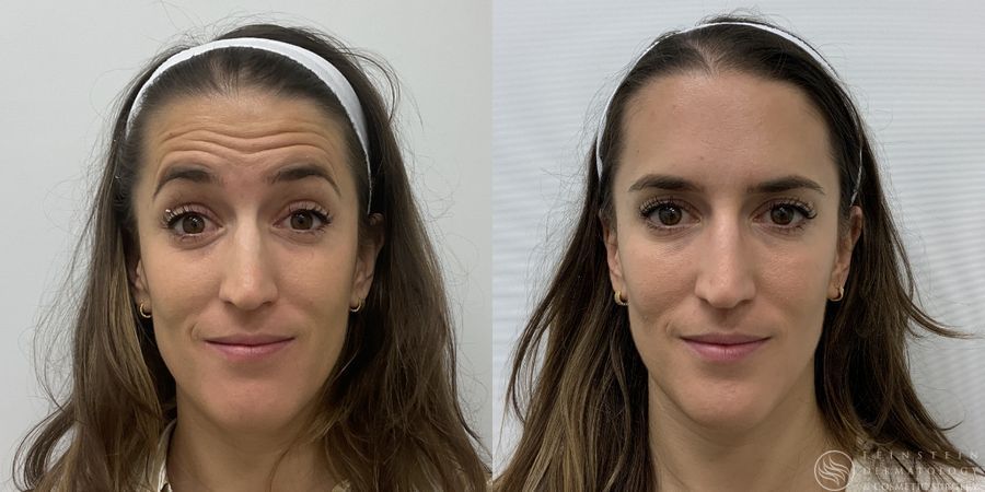 Botox Cosmetic, Dysport, Jeveau - Thumbnail 3