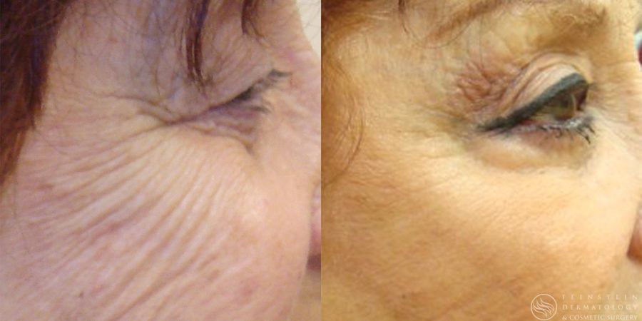 Botox Cosmetic, Dysport, Jeveau - Case 12240