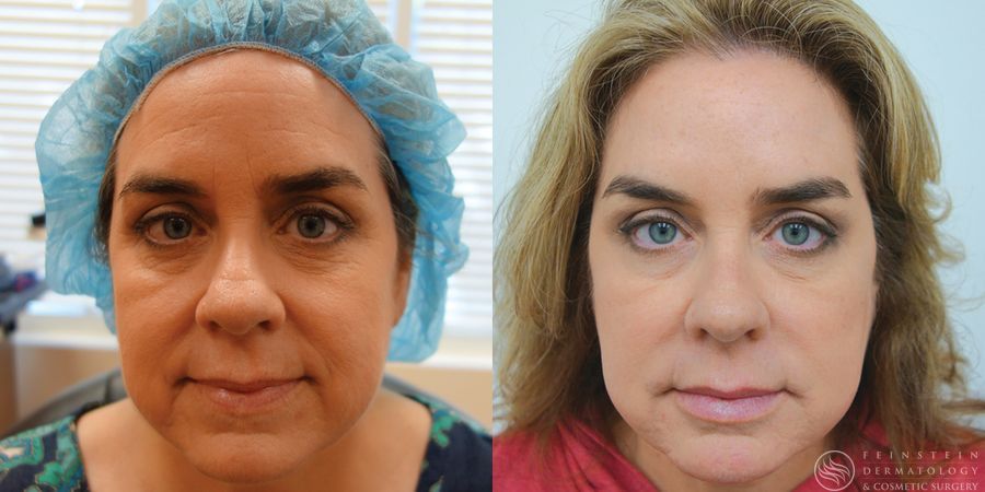 Botox Cosmetic, Dysport, Jeveau - Case 12249