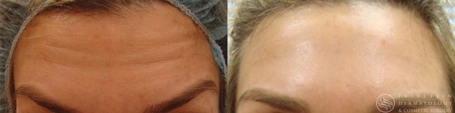 Botox Cosmetic, Dysport, Jeveau - Case 12241
