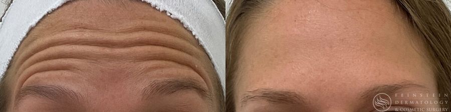 Botox Cosmetic, Dysport, Jeveau - Case 12247