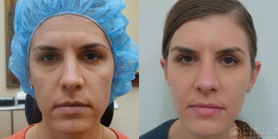 Botox Cosmetic, Dysport, Jeveau - Case 12250