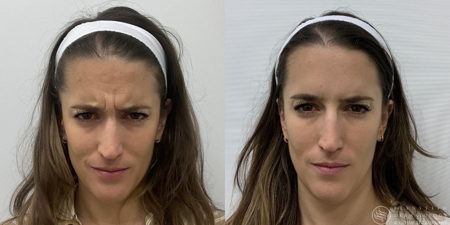 Botox Cosmetic, Dysport, Jeveau - Case 12236