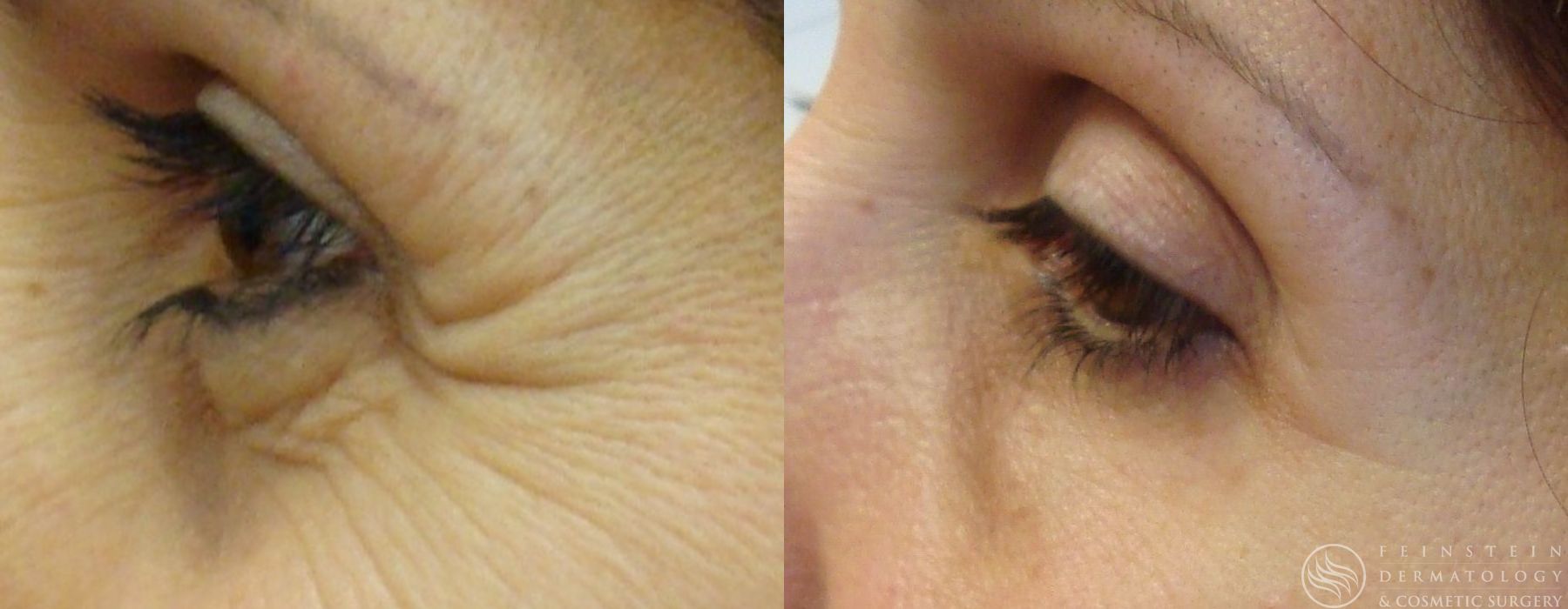 Botox Cosmetic, Dysport, Jeveau - Case 12232