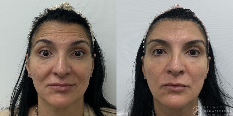 Botox Cosmetic, Dysport, Jeveau - Case 12237