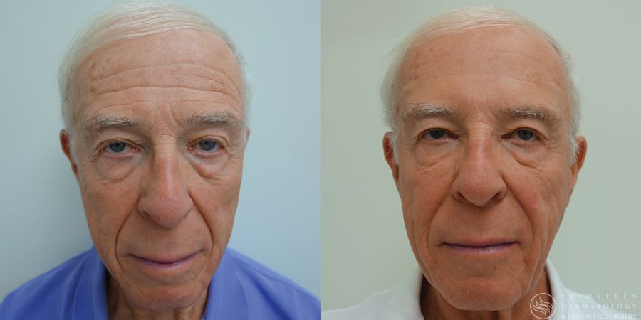 Botox Cosmetic, Dysport, Jeveau - Case 12248