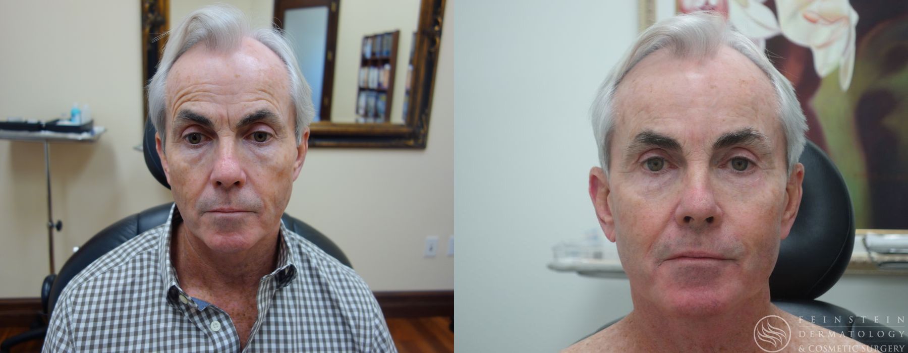 Botox Cosmetic, Dysport, Jeveau - Case 12234