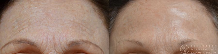 Botox Cosmetic, Dysport, Jeveau - Case 12244