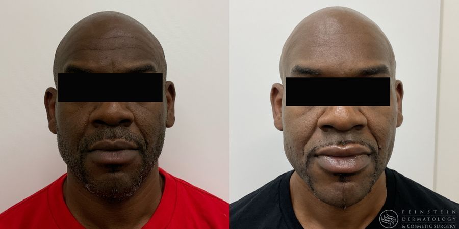 Botox Cosmetic, Dysport, Jeveau - Case 12239