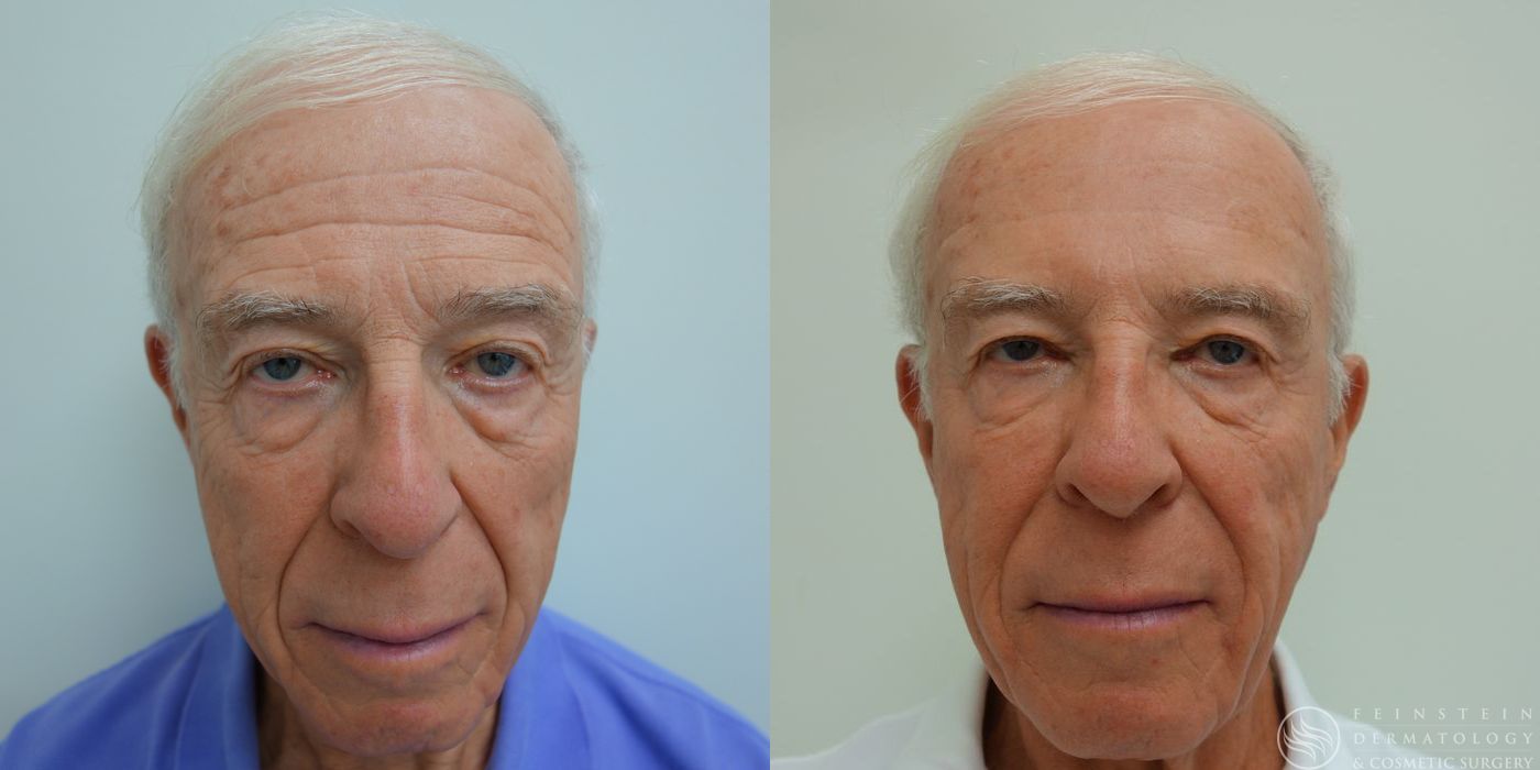 Botox Cosmetic, Dysport, Jeveau - Case 12233