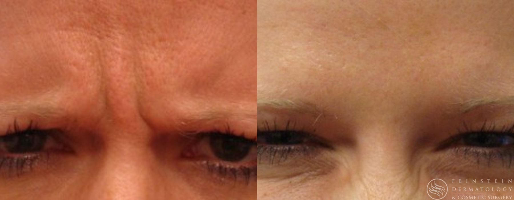 Botox Cosmetic, Dysport, Jeveau - Case 12230