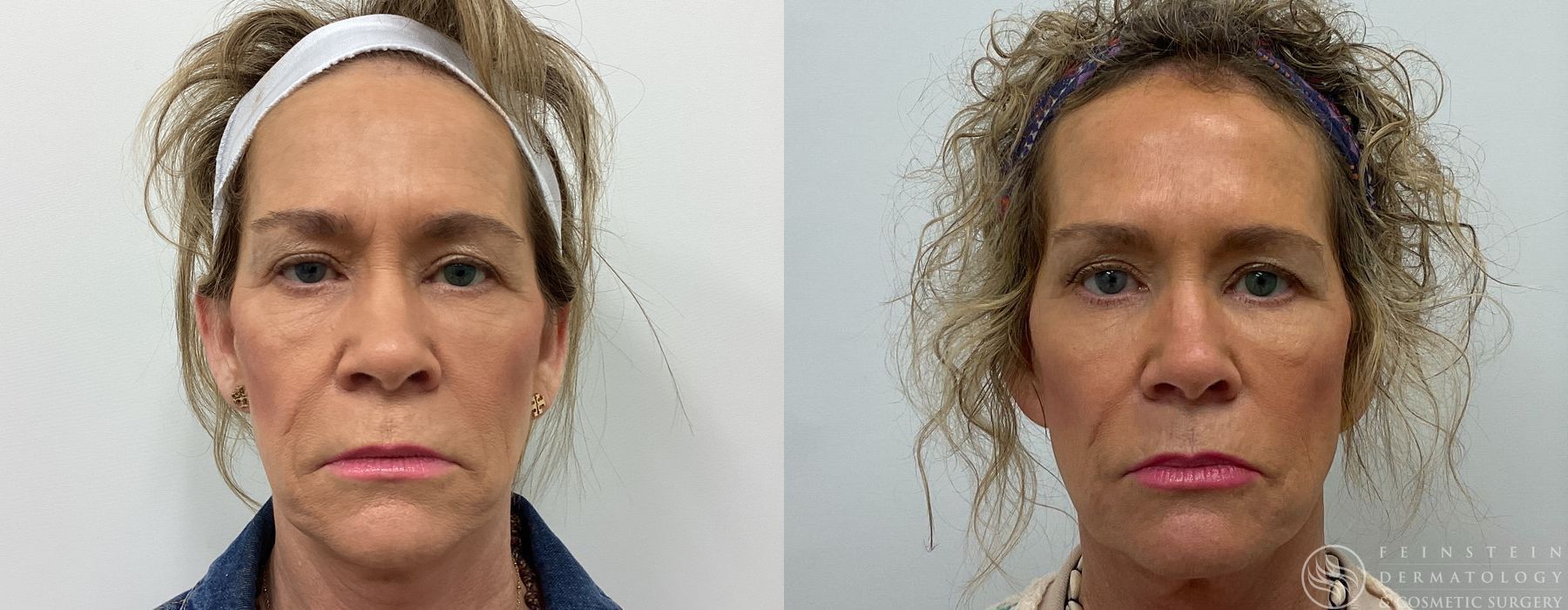 Botox Cosmetic, Dysport, Jeveau - Case 12229