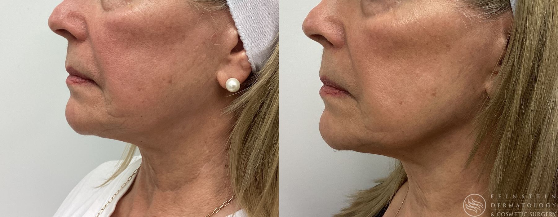 Botox Cosmetic, Dysport, Jeveau - Case 12228