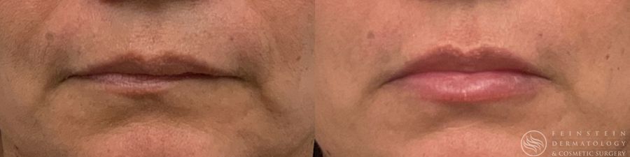 Dermal Fillers - Case 12281