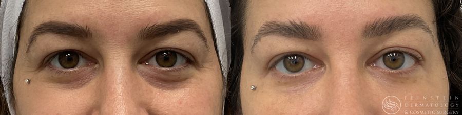 Dermal Fillers - Case 12287