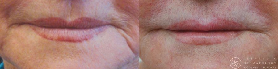 Dermal Fillers - Case 12262