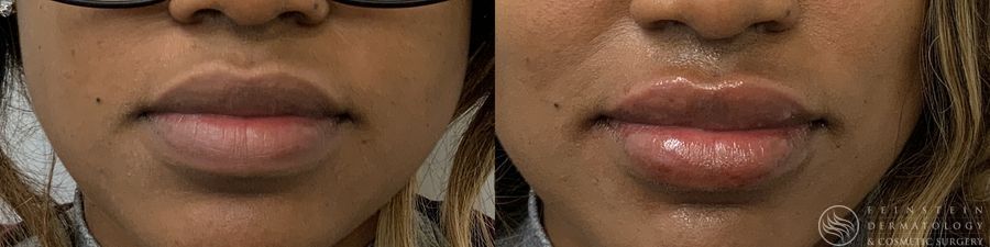 Dermal Fillers - Case 12293
