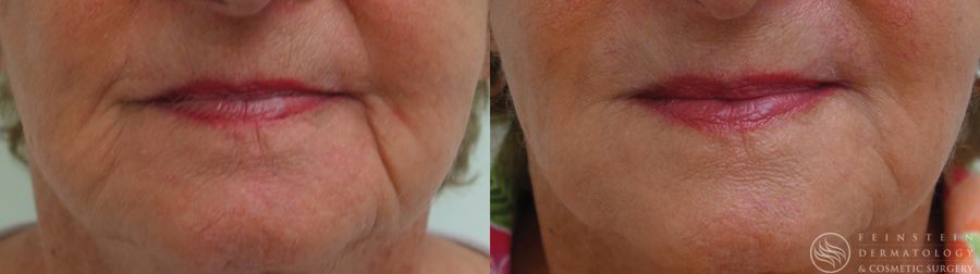 Dermal Fillers - Case 12278